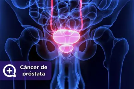 Cáncer de Próstata - Diagnóstico y Tratamiento